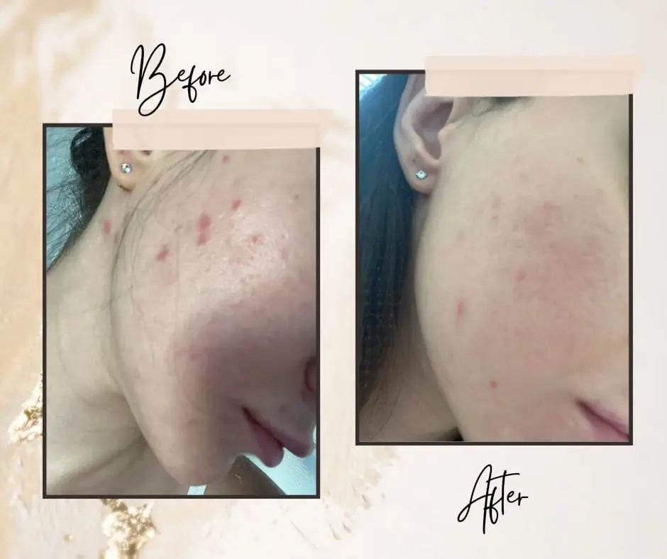 Customer Success Stories: How Our Anti-Acne Ice Globe Transformed Skin ANGEL CARE